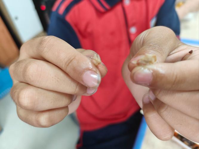 手指放血 脑梗 果壳