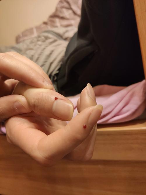 手指放血 脑梗 果壳