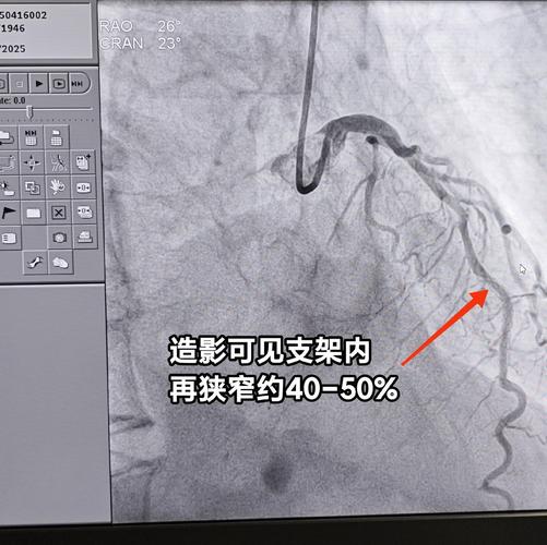 心梗支架后会得脑梗吗