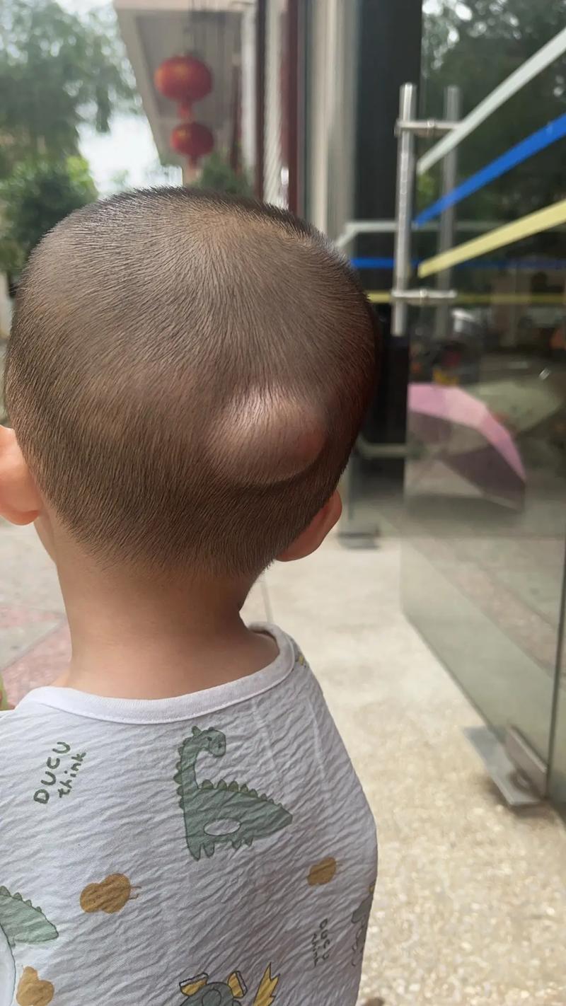 脑梗后脑水肿轻度脑疝