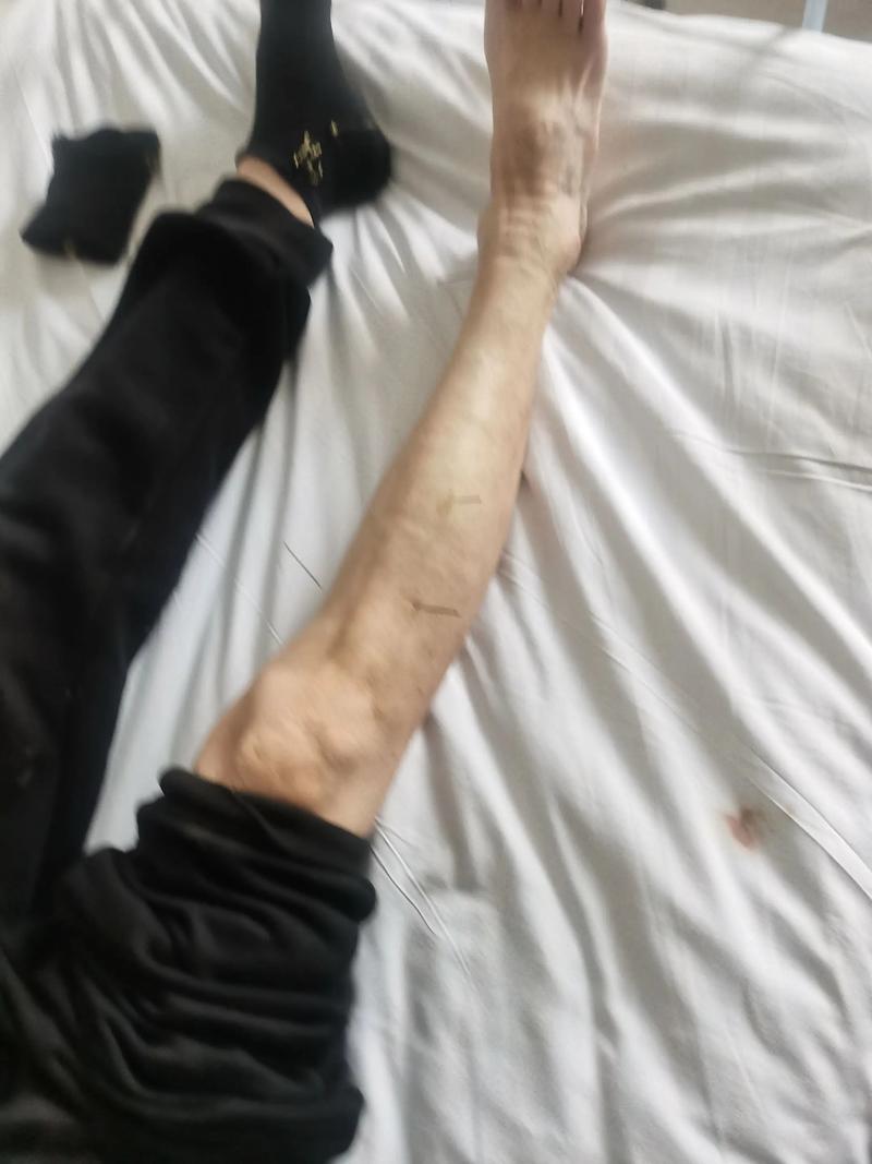 早晨 右手发麻 脑梗