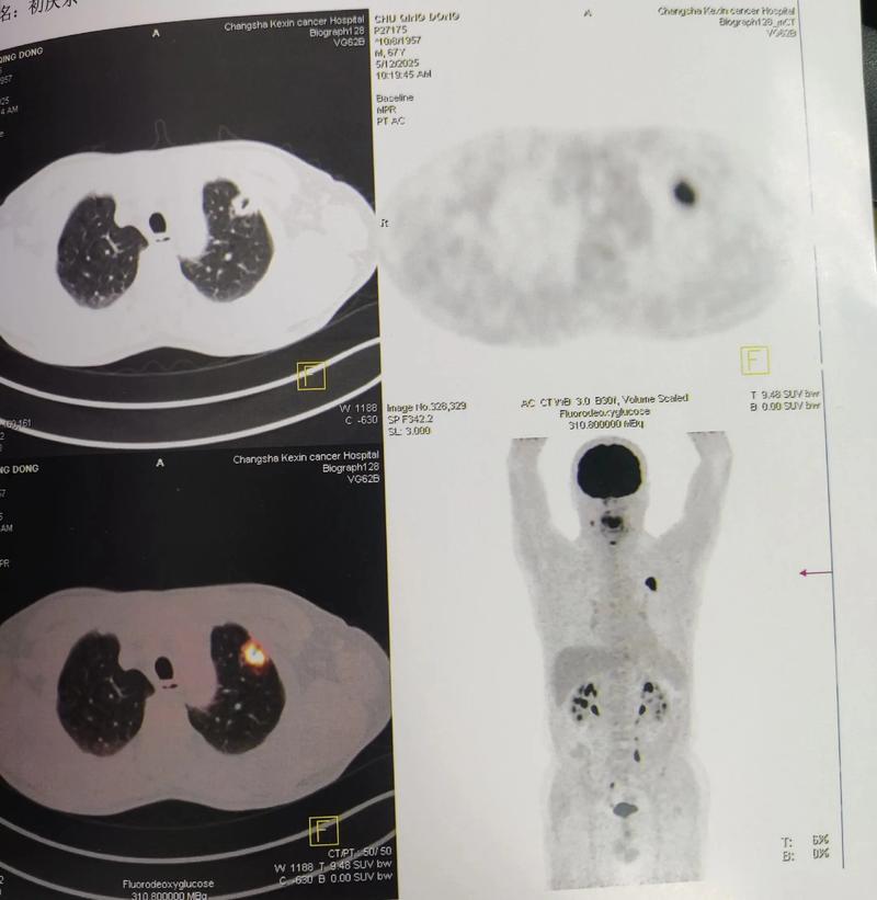 petct能检查脑梗