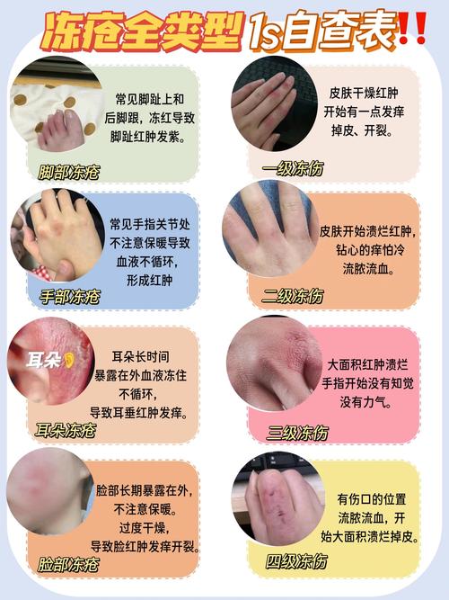 冻的是风湿还是类风湿