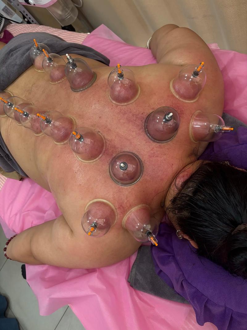 风湿类风湿拔罐的位置