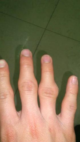 类风湿抗O类风湿阳性