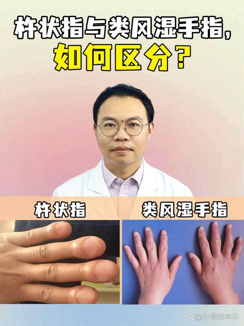 风湿和类风湿的区别是