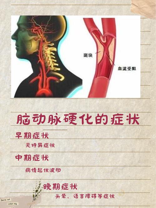 脑梗属于脑动脉硬化吗