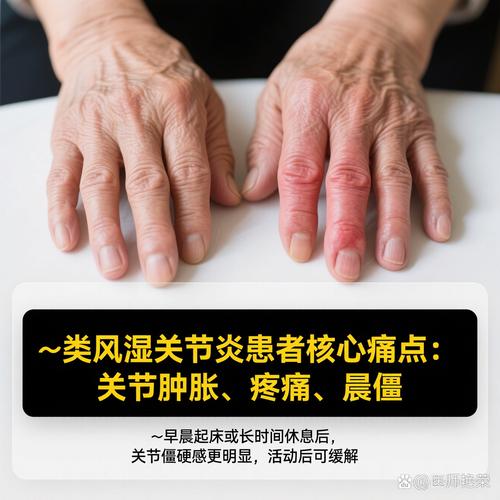 风湿能发展成类风湿吗