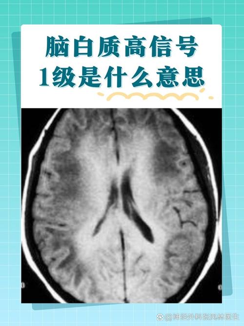 脑白质缺血灶是脑梗吗