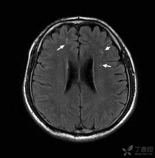 脑白质缺血灶是脑梗吗