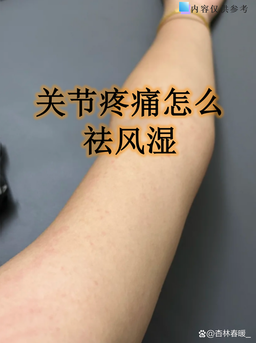 风湿类风湿需要去湿吗