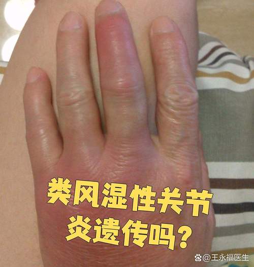 风湿类风湿超敏反应高