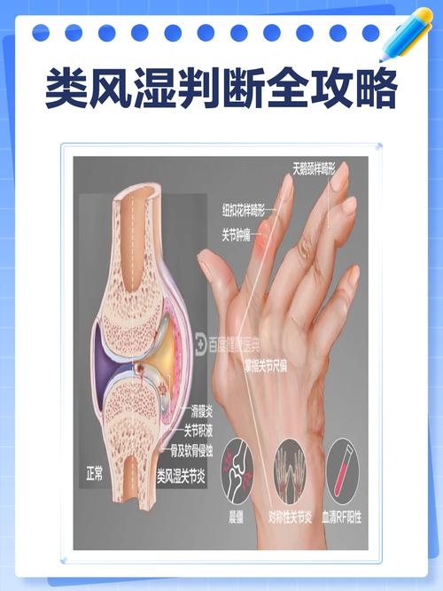 类风湿比风湿要严重吗