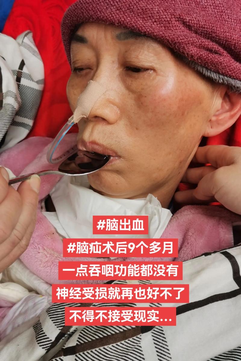 79岁脑梗发展成脑疝
