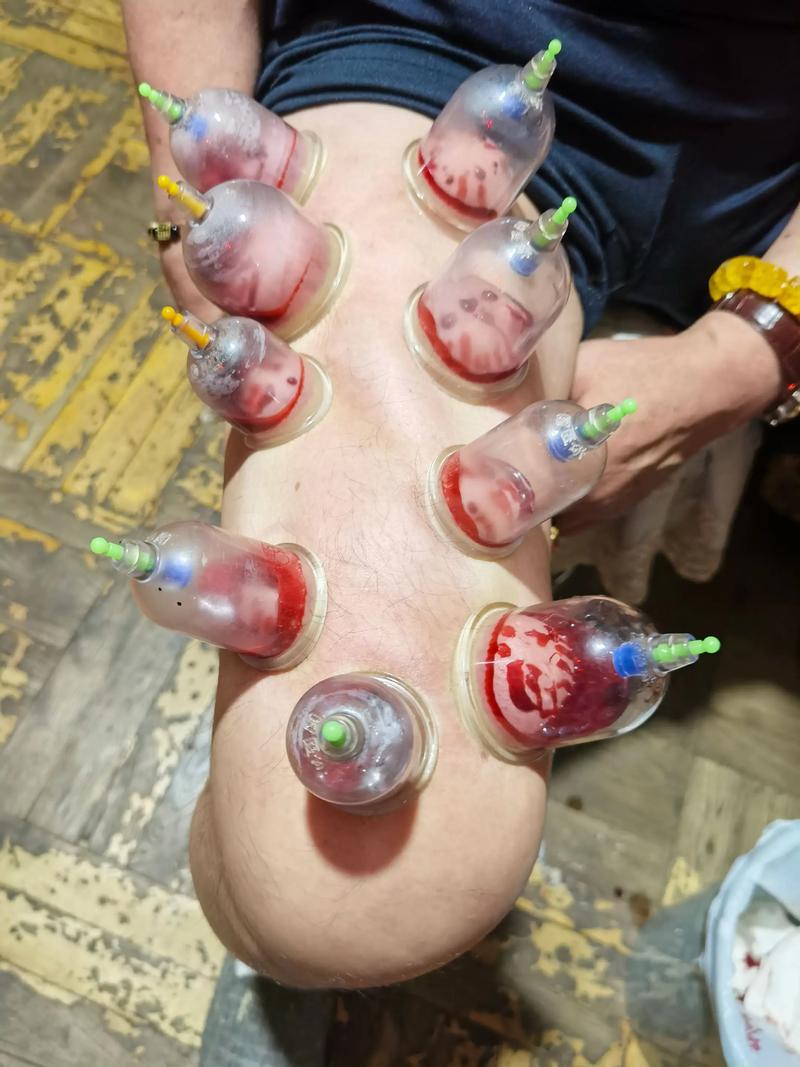 感冒拔火罐拔哪个穴位