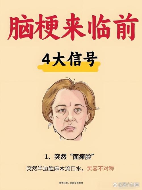 脑梗面瘫 言语 吞咽