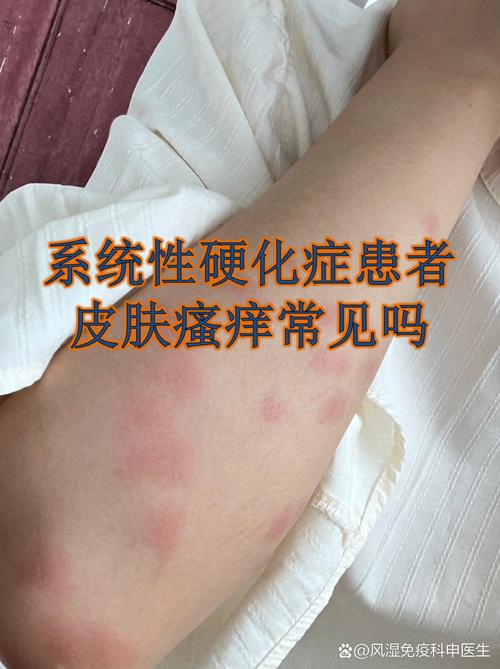 长春苏英杰风湿类风湿