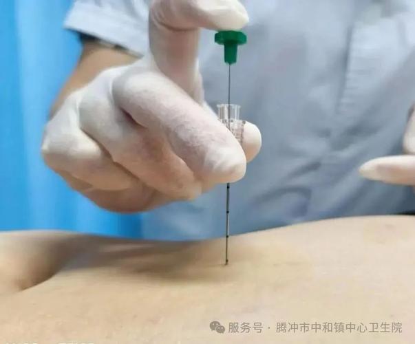 中医穴位埋线减肥疗法