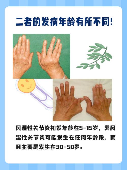 如何辨别风湿和类风湿