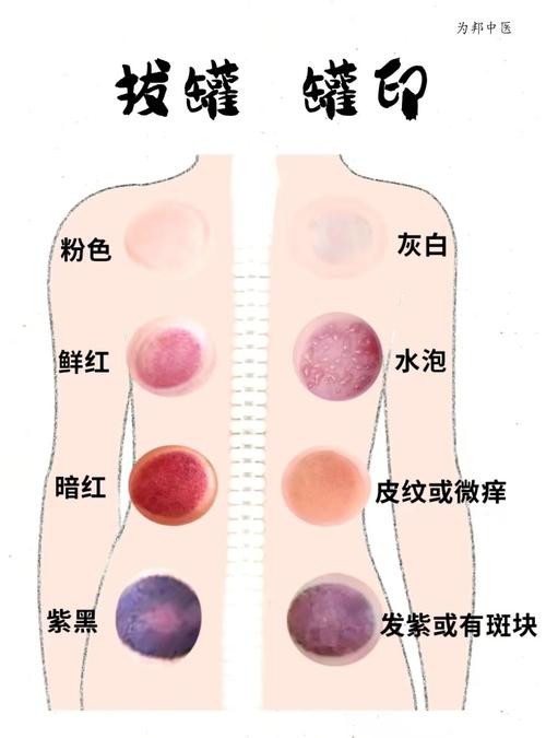 人体哪些穴位不能拔罐