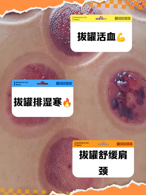 人体哪些穴位不能拔罐