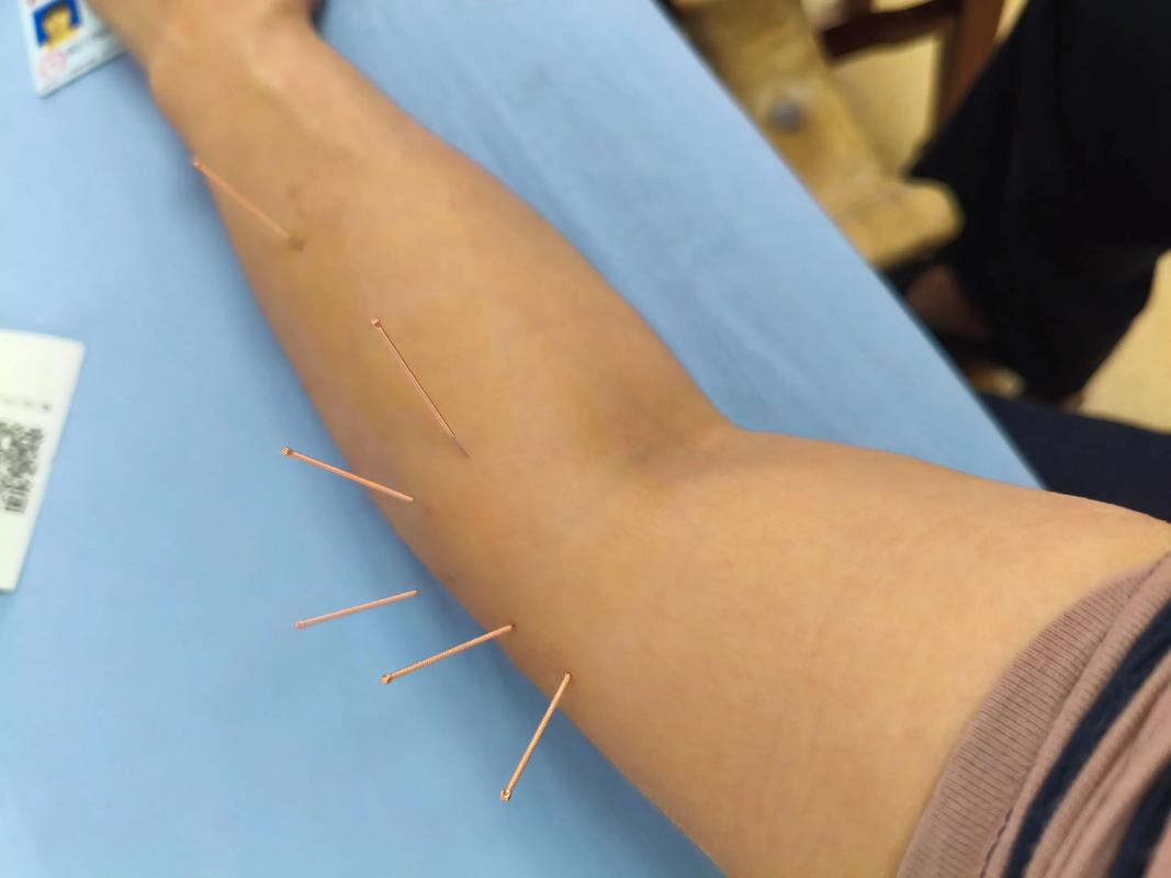 风湿类风湿可以针炙吗