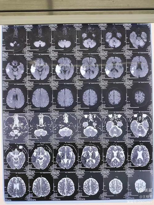 核磁提示脑内多发脑梗