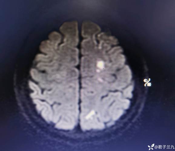 核磁提示脑内多发脑梗