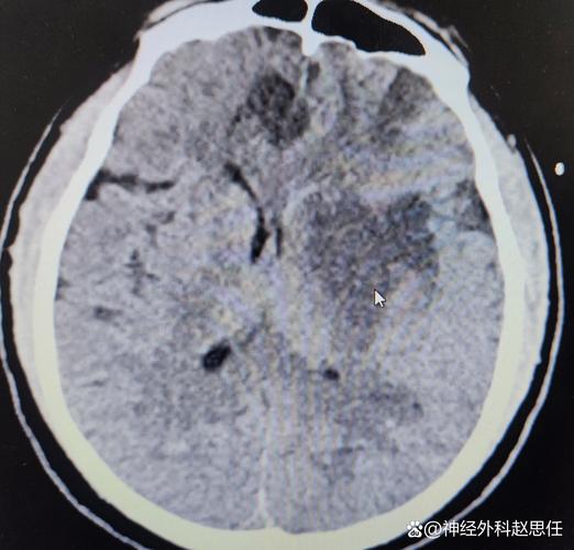 左脑大面积脑梗 昏迷