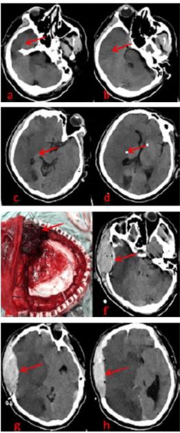 左脑大面积脑梗 昏迷