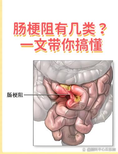 脑梗病人肠梗堵有什么