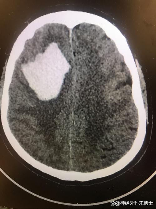 手术后左脑小面积脑梗