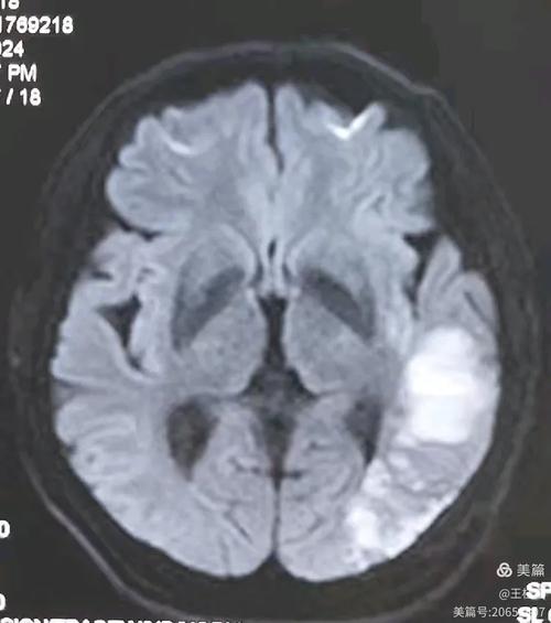 手术后左脑小面积脑梗