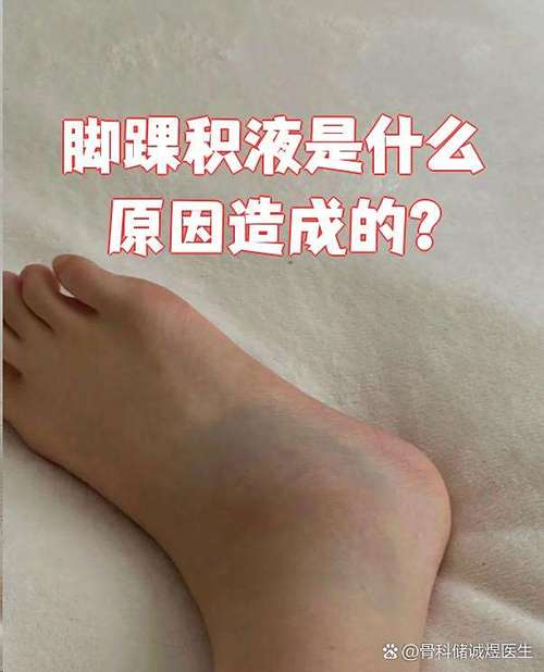 积水是风湿还是类风湿