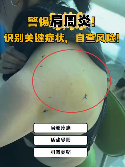 风湿性肩周炎属于风湿