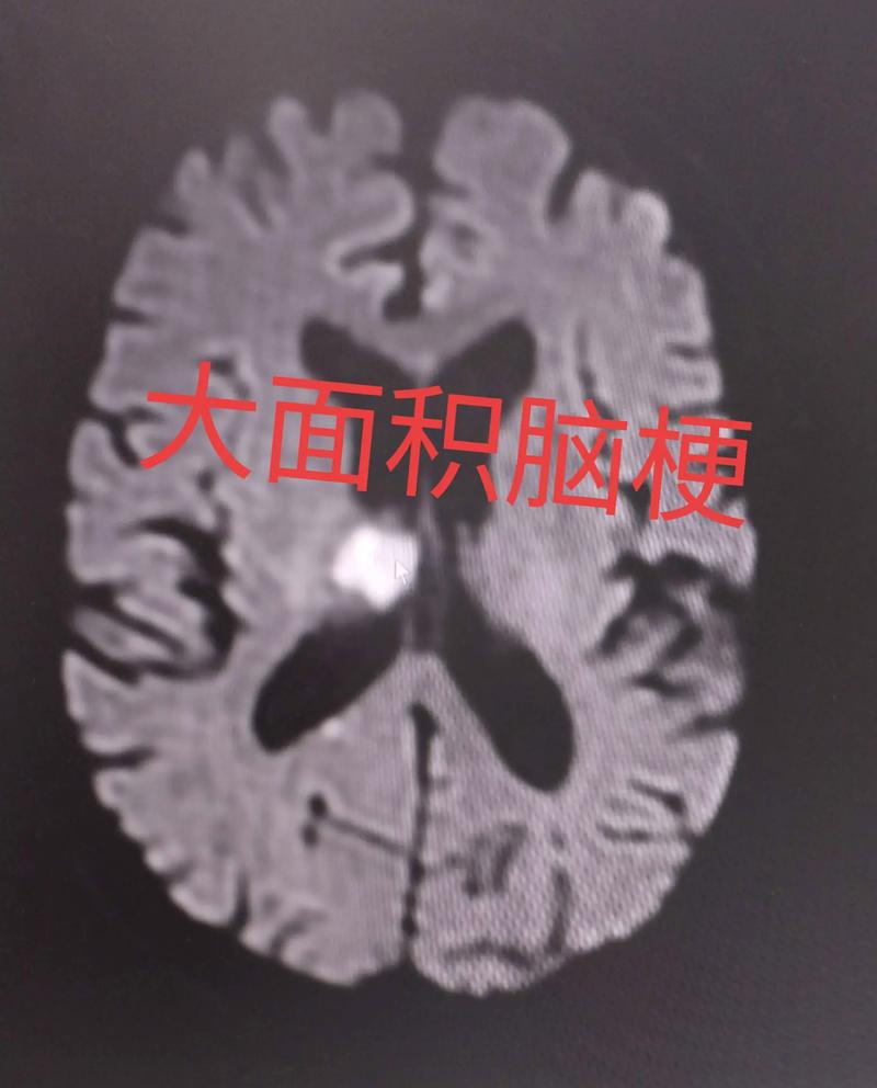 脑梗和腔梗CT的区别