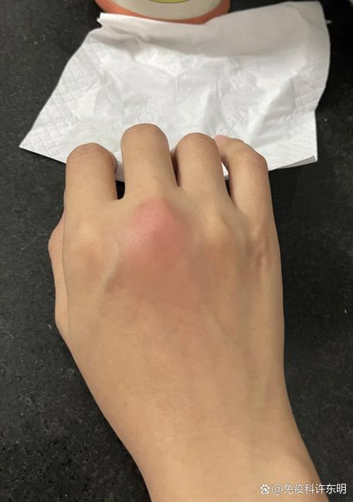 风湿类风湿阴性 晨僵