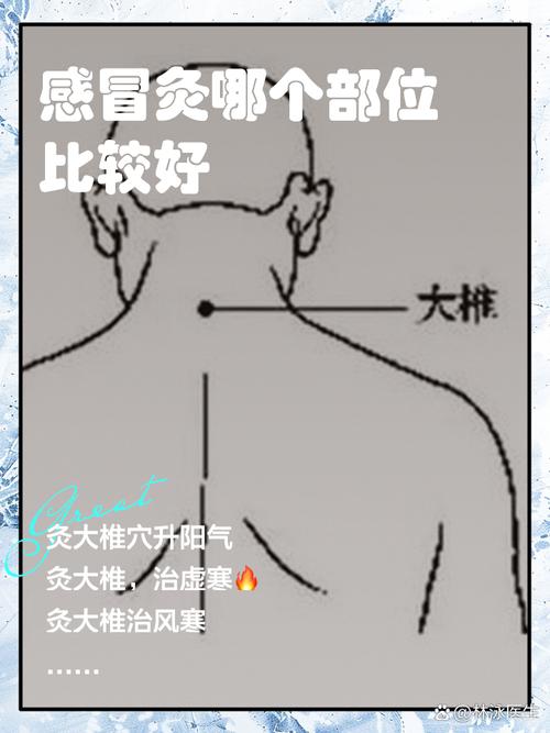 风寒感冒艾灸什么穴位