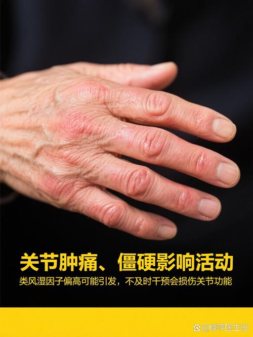 产后风湿类风湿因子高