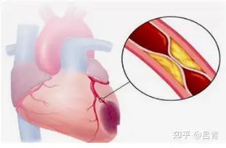血压多少能得脑梗心梗