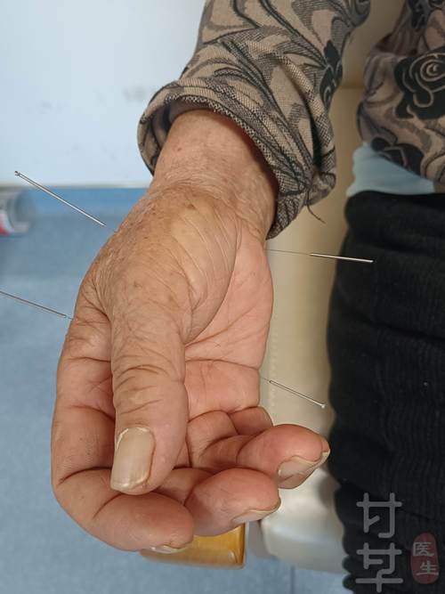 针灸治疗类风湿和风湿