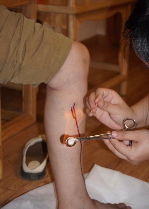 针灸治疗类风湿和风湿