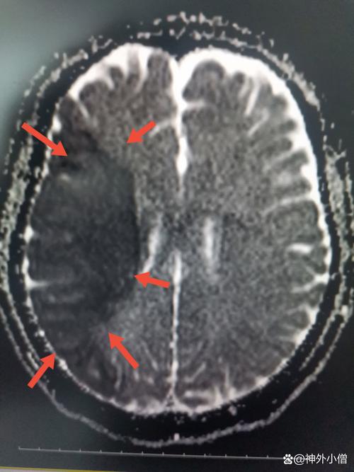 右侧侧脑旁脑梗严重吗