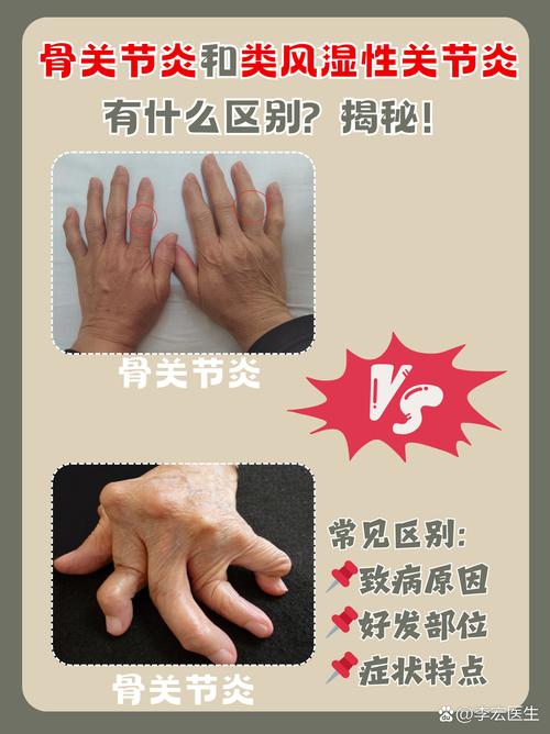 风湿和类风湿简单区别