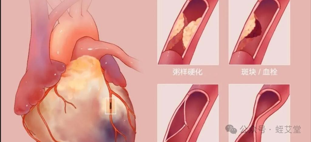 心梗装支架后诱发脑梗