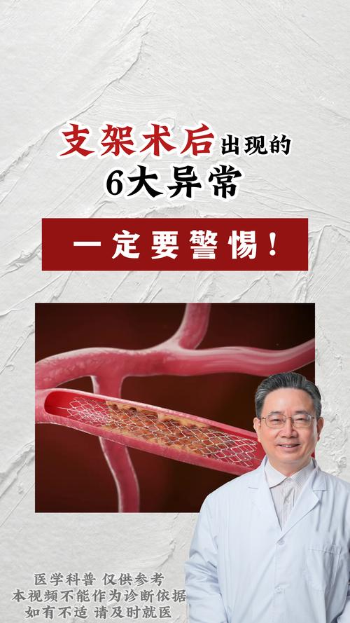 心梗装支架后诱发脑梗