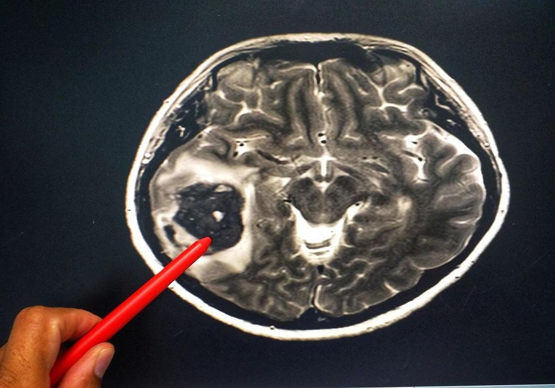 脑梗脑白质变性脑萎缩