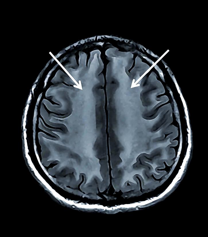 脑梗脑白质变性脑萎缩