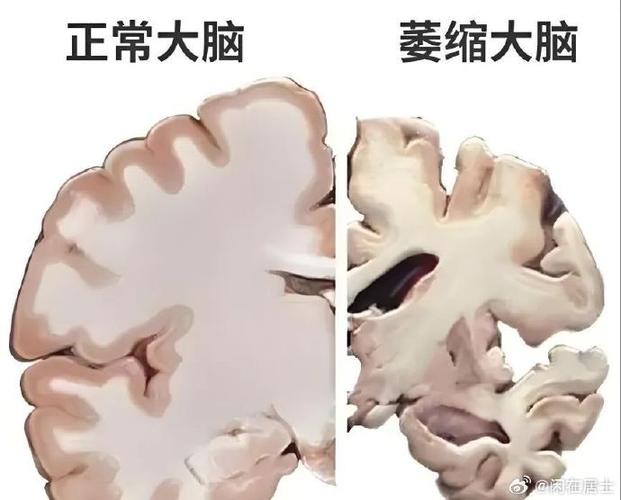 脑梗脑白质变性脑萎缩