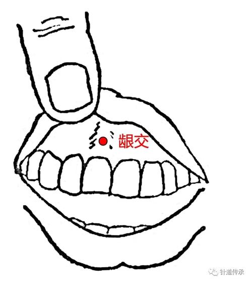 龈交穴位治疗痔疮视频